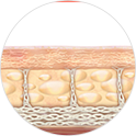 After Ulthera: gradual lifting and firmness improvement
